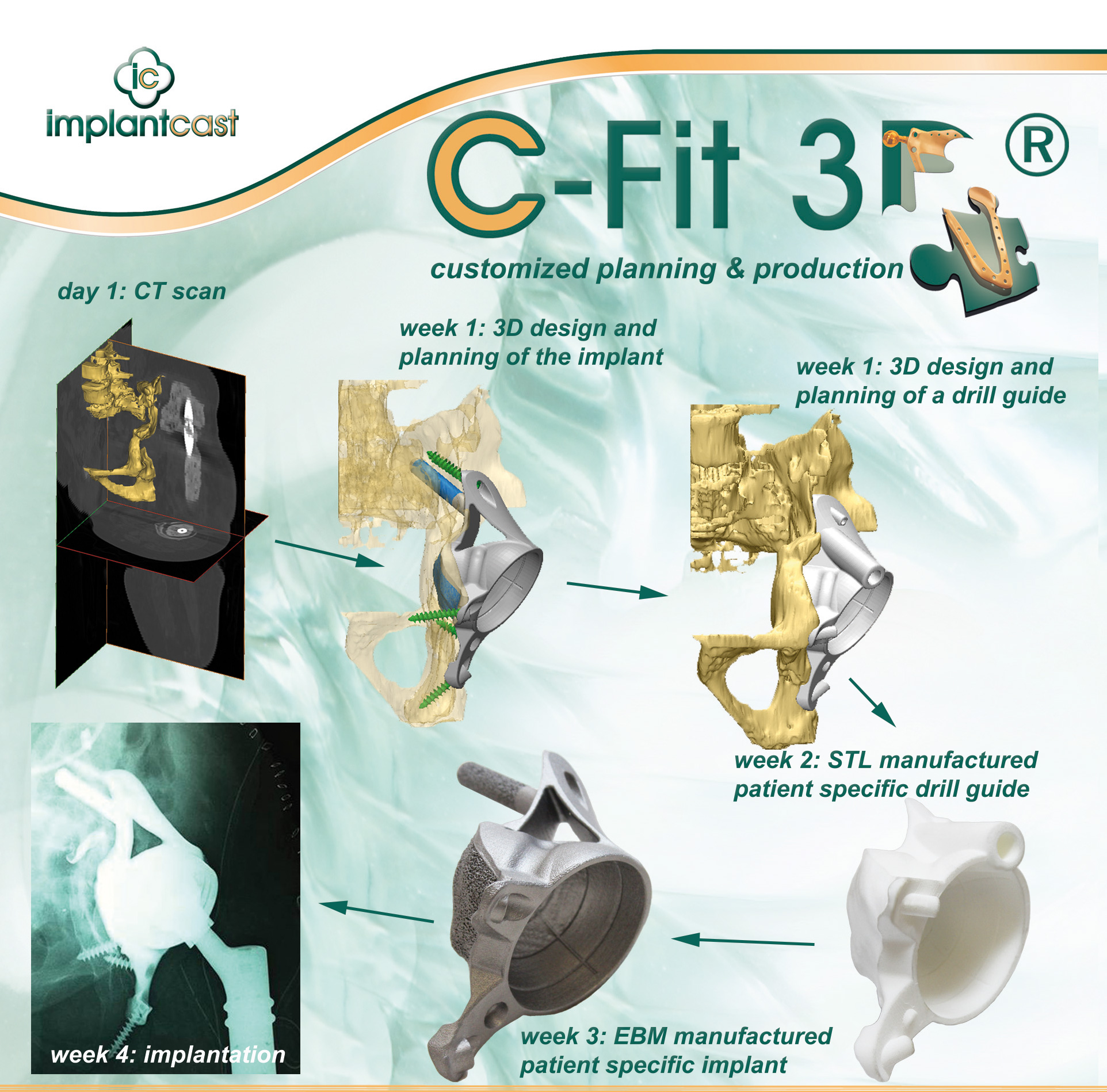 Custom Orthopedic Implants | Implantcast North America
